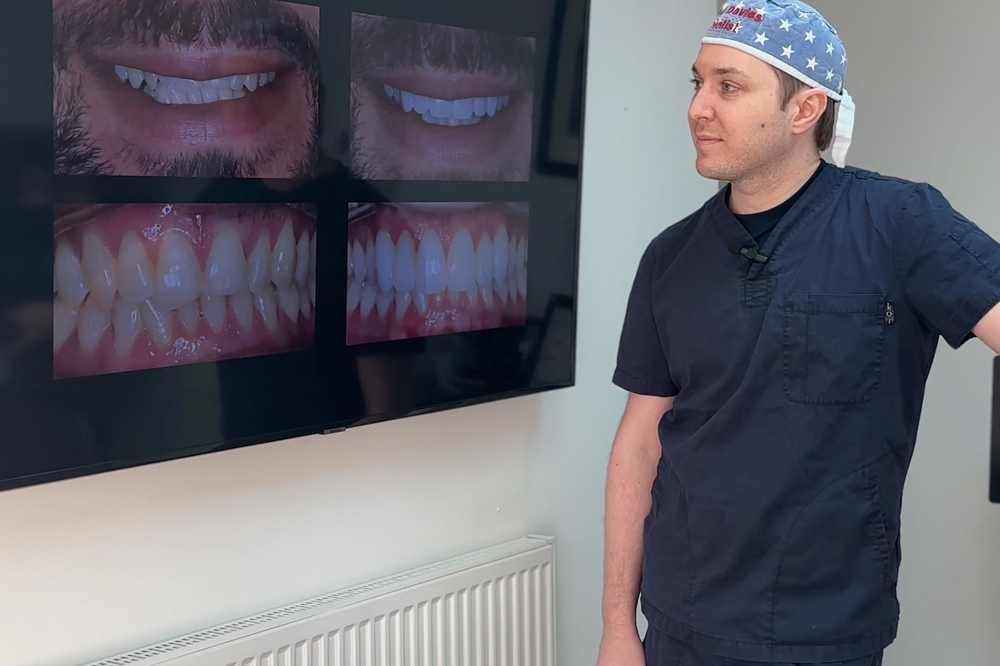 Tooth Whitening