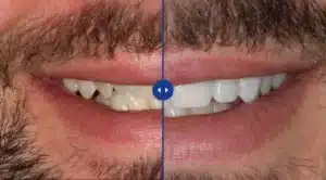 Composite Bonding for Gaps and Chips