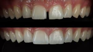 Composite Bonding for Gaps and Chips