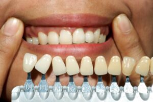 Composite Bonding for Gaps and Chips