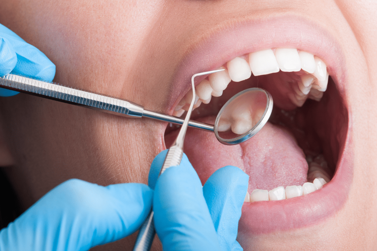 Composite Bonding for Gaps and Chips